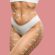 Tummy Tuck