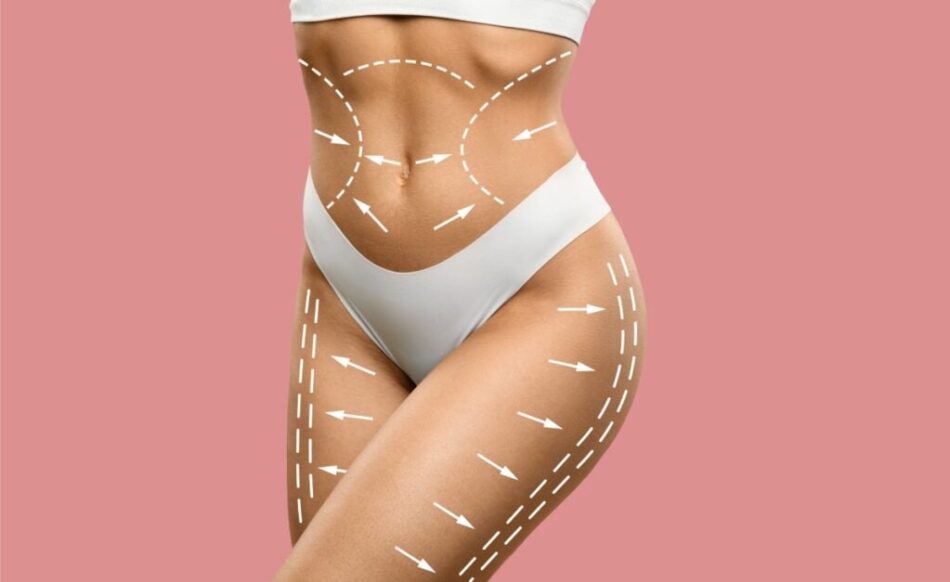 Tummy Tuck