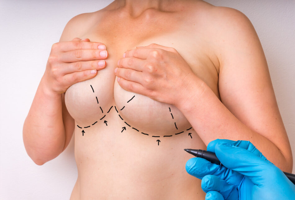 Achieve Balanced and Proportional Results with Breast Lift Surgery