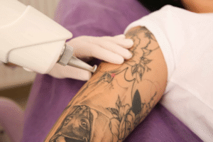 Advanced Laser Tattoo Removal for All Skin Types
