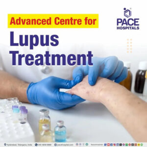 Lupus Treatment in Hyderabad