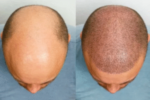 Hair Transplant in Dubai