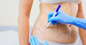 Does Liposuction Surgery Worth the Money?