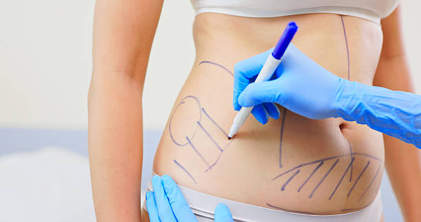 Does Liposuction Surgery Worth the Money?