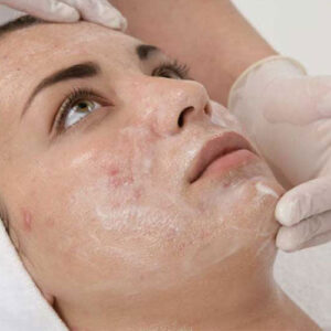 Facial rejuvenation peel