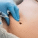 Fat Melting Injection in Dubai