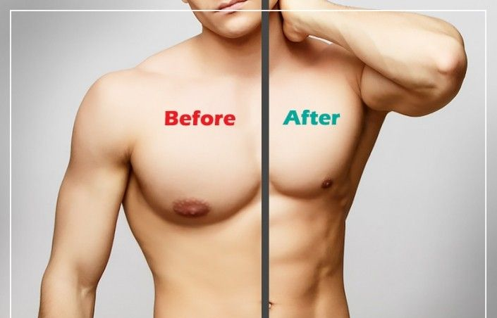 Gynaecomastia Surgery in Dubai