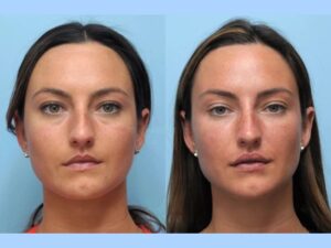 Thread Lift in Dubai: The Secret to a Youthful Appearance