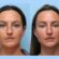 Thread Lift in Dubai: The Secret to a Youthful Appearance