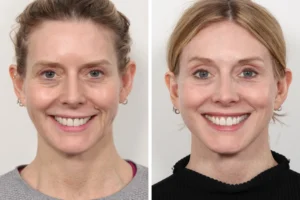 Custom Thread Lift Consultations at the Best Aesthetic Clinic in Dubai