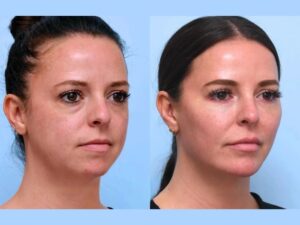 Best Doctors in Dubai: Thread Lift Experts Who Deliver Impressive Long Lasting Results