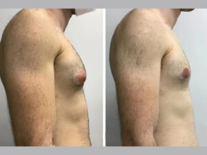 gynecomastia in dubai
