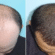 Hair Transplant in Dubai