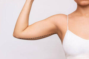 How Arm Lift Helps Remove Sagging Upper Arm Skin