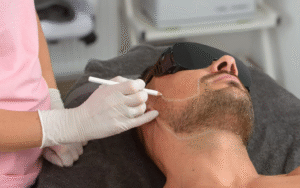How Can Beard Laser Hair Removal Define Jawline Shape