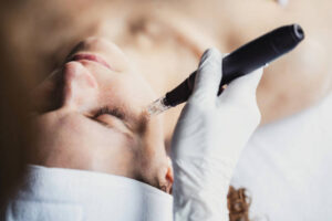 How Dermapen Microneedling Reduces Acne Scars Safely