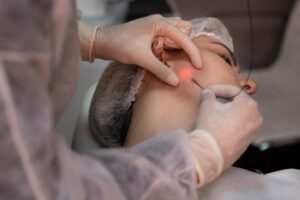 How Does Endolift Improve Skin Elasticity Naturally