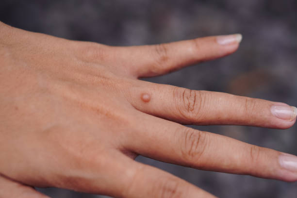 How Genital Warts Removal Restores Skin Confidence