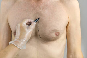 How Gynecomastia Surgery Helps Remove Chest Fat Safely