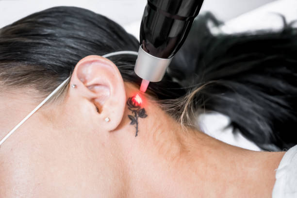 How Laser Tattoo Removal Works on Old, Dark Tattoos