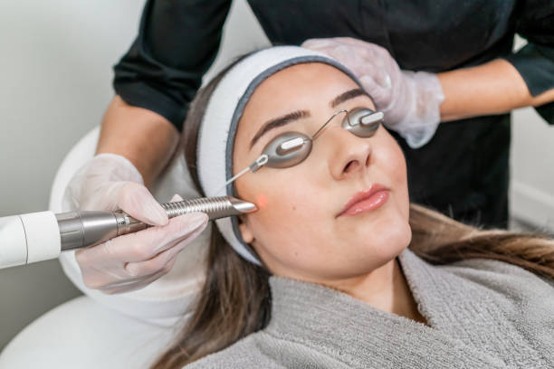How Laser Treatments Help Reduce Acne Scars Safely