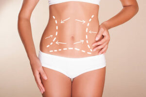 How Liposuction Helps Remove Stubborn Fat Effectively