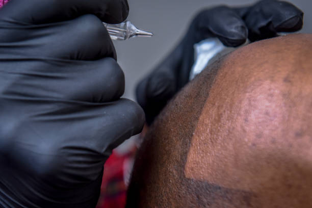How Scalp Micropigmentation Cost Impacts Your Results