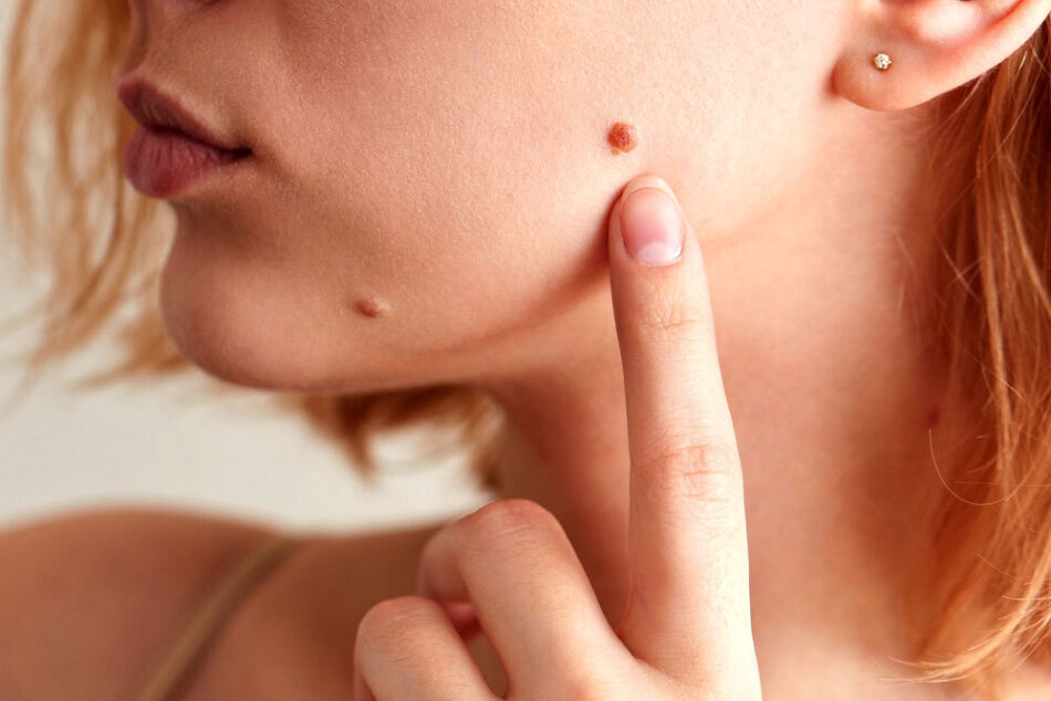 How Skin Lesion Removal Restores Skin Confidence