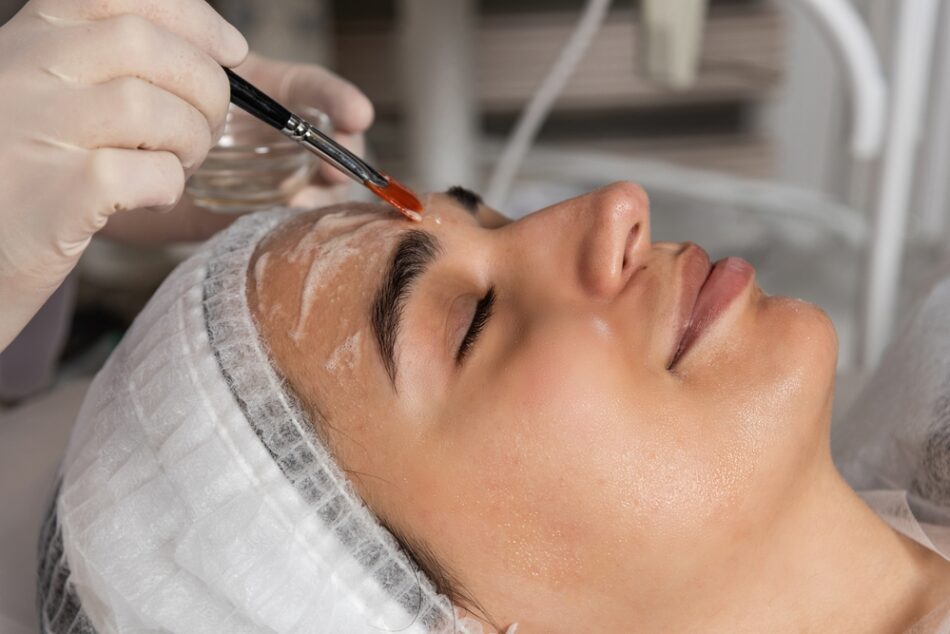 Is Inno Peel the Best Chemical Peel Option?
