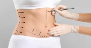 Liposuction in Islamabad
