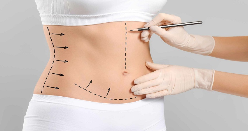 Liposuction in Islamabad