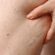 Non-Invasive Varicose Vein Treatment