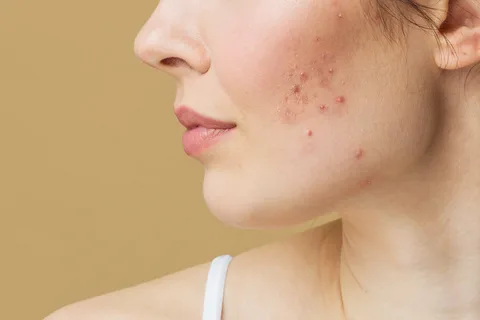 Pimples Treatment in Dubai