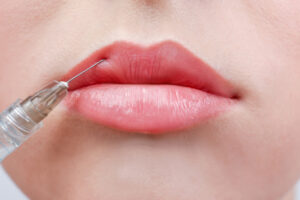 Redefine Your Beauty with Russian Lip Fillers