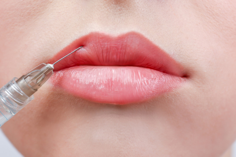 Redefine Your Beauty with Russian Lip Fillers