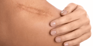 Regain Your Natural Appearance with Burn Reconstructive Surgery