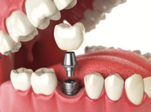 How to Care for Implants to Make Them Last a Lifetime