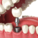 How to Care for Implants to Make Them Last a Lifetime