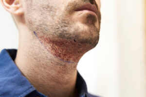 What Factors Affect Beard Hair Transplant Cost