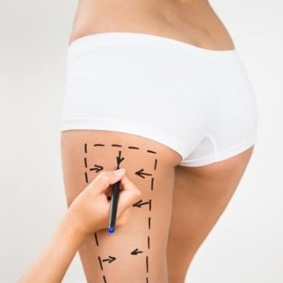 What Makes a Thigh Lift Ideal for Sagging Skin