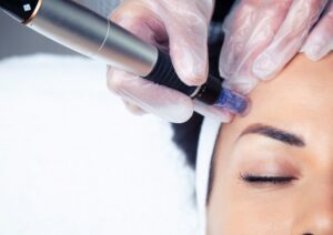 What Results to Expect After Dermapen Treatment?