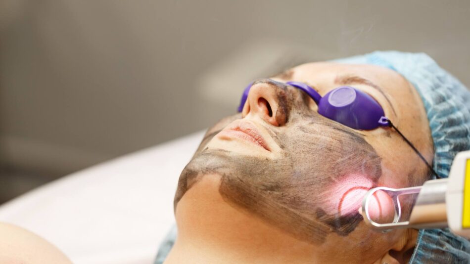 What’s the Ideal Age to Start Laser Carbon Peel Treatments?