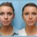 Thread Lift in Dubai Redefines Facial Contours Without Cuts Stitches or Long Recovery