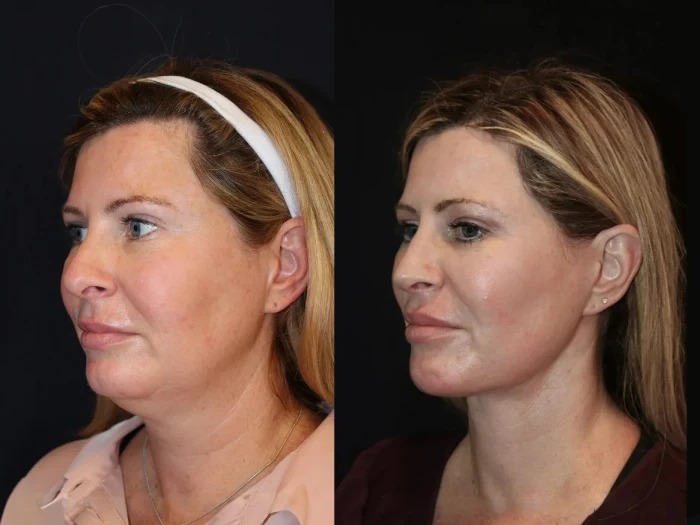 Achieve Firm, Smooth & Lifted Skin with Skin Tightening Treatment in Dubai