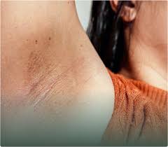 Why armpits darken after peeling
