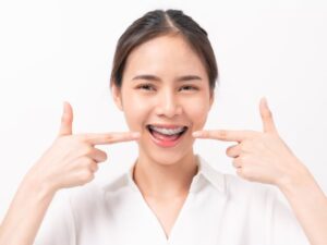 how much are braces