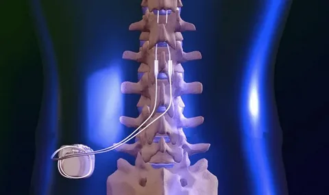 Advanced Spine Surgery: Modern Solutions for Back Pain