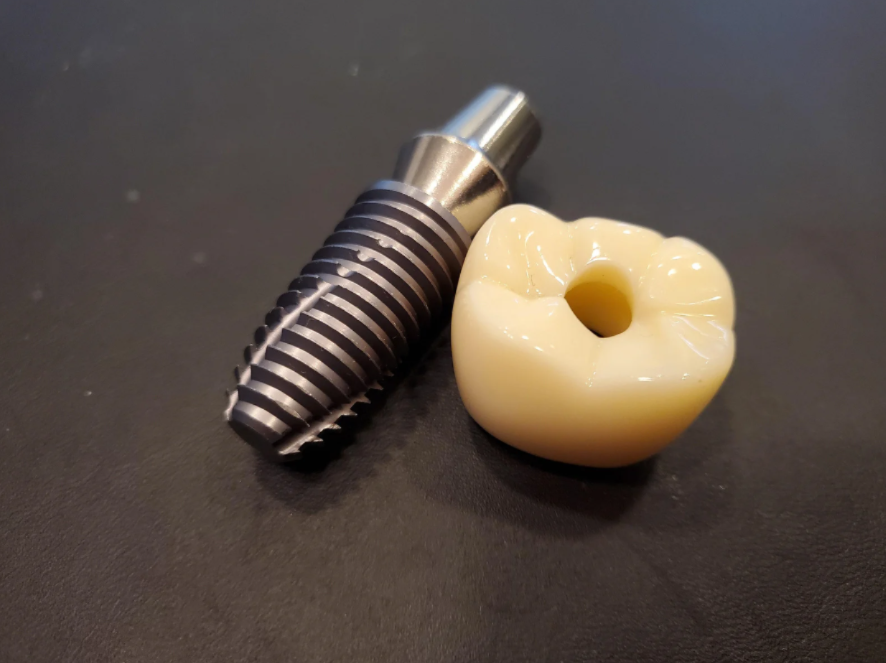Dental Crown, Fairfax, VA