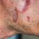 investigative treatment for cutaneous lupus