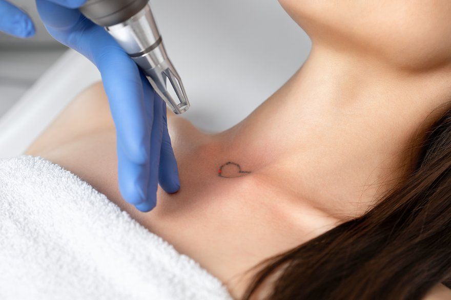 Tattoo Removal in Dubai